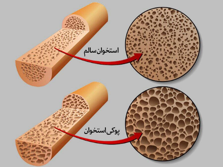 این عادت غلط رایج باعث پوکی و شکستگی استخوان می‌شود