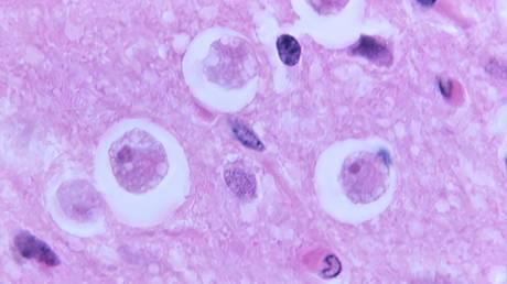 Brain-eating amoeba kills 19 in India