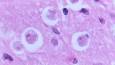 Brain-eating amoeba kills 19 in India