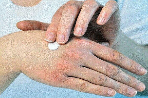 چگونه از خشکی پوست در پاییز جلوگیری کنیم؟