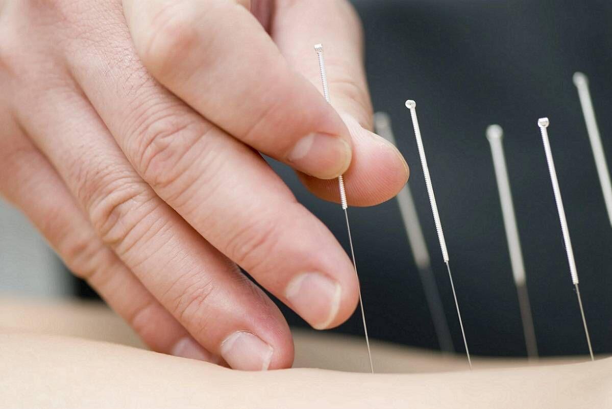 تاثیر طب سوزنی در کاهش تسکین کمردرد مزمن